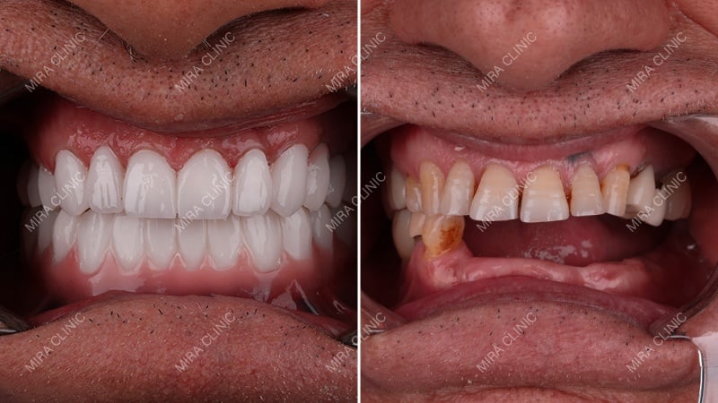 Dental Implants Before and after